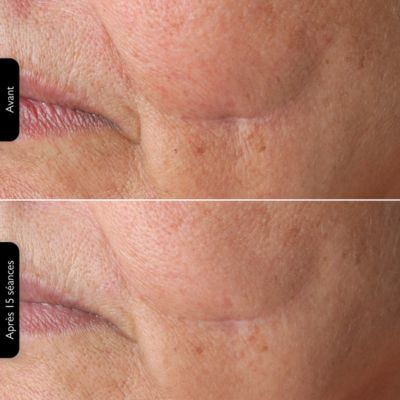 Voir la vidéo pour Appareil anti rides SILK'N FaceTite Multiplatform FTMP1PE1001